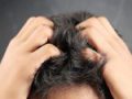 10 wskazówek, jak dbać o swędzącą skórę głowy